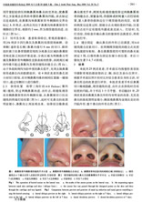 埋线法鼻尖及鼻翼沟成形的临床观察2.jpg