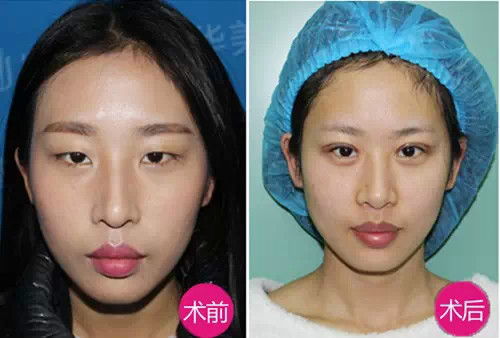 陈永精雕美眼炯目术